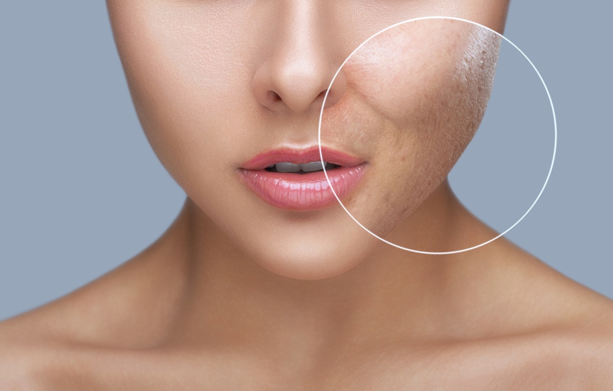 методы лечения постакне